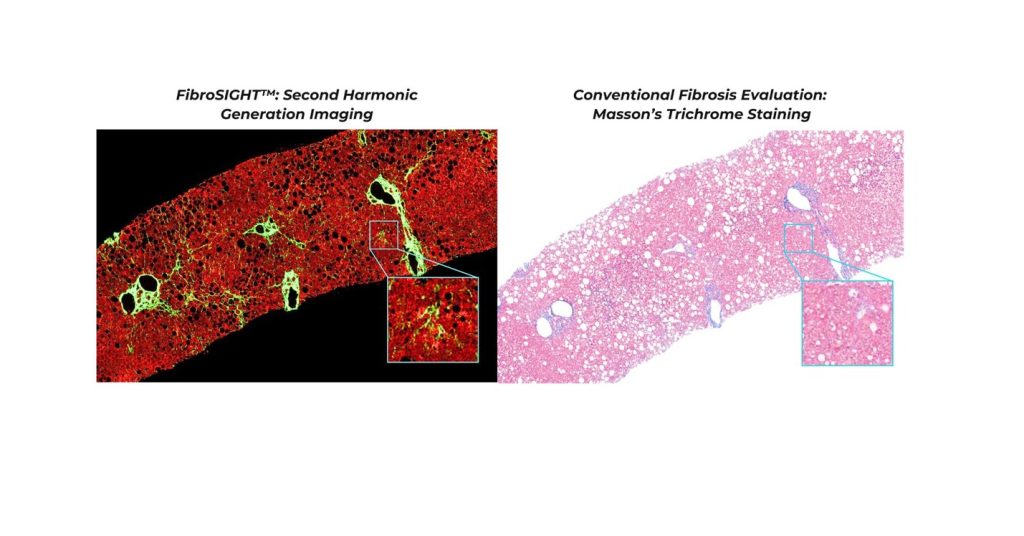 A New Standard in Clinical Care for MASH Patients: HistoIndex Launches FibroSIGHT