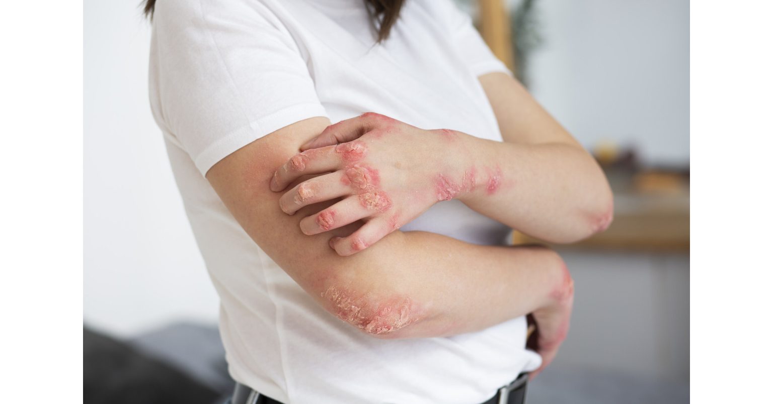 Why Chronic Eczema Can Last for Decades, and What a Recent Case Is Revealing
